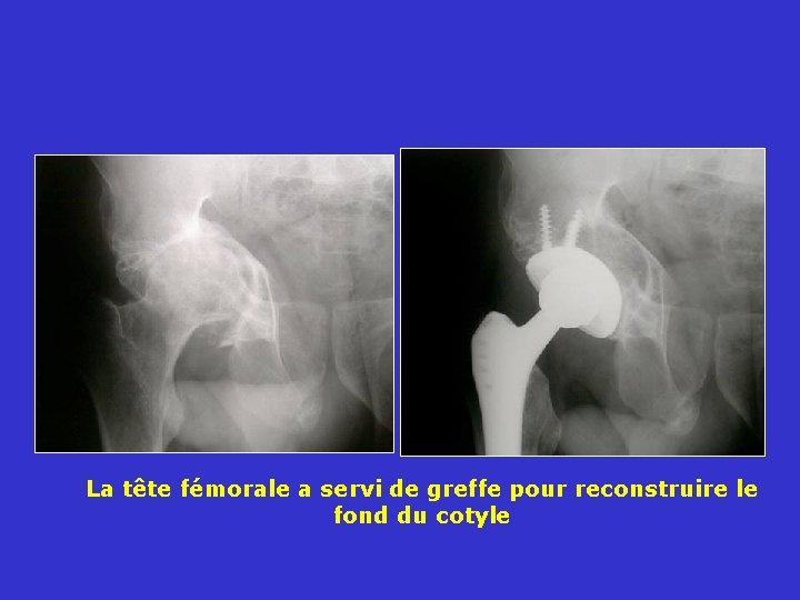 La tête fémorale a servi de greffe pour reconstruire le fond du cotyle 