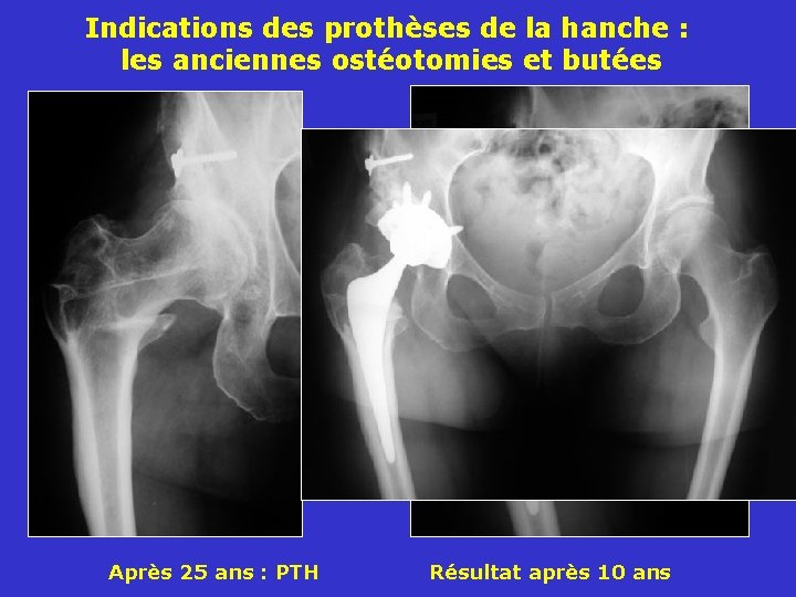 Indications des prothèses de la hanche : les anciennes ostéotomies et butées Après 25