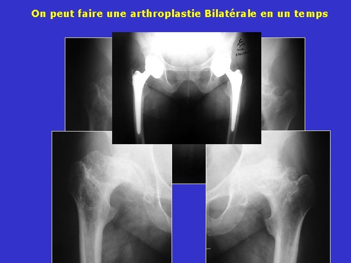 On peut faire une arthroplastie Bilatérale en un temps 