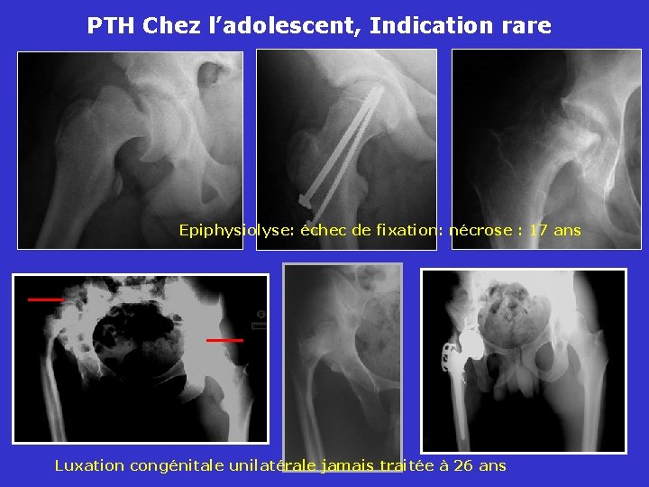 PTH Chez l’adolescent, Indication rare Epiphysiolyse: échec de fixation: nécrose : 17 ans Luxation