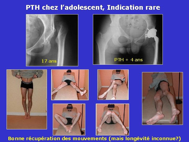 PTH chez l’adolescent, Indication rare 17 ans PTH + 4 ans Bonne récupération des