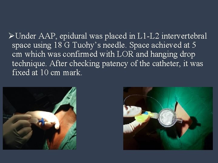 ØUnder AAP, epidural was placed in L 1 -L 2 intervertebral space using 18