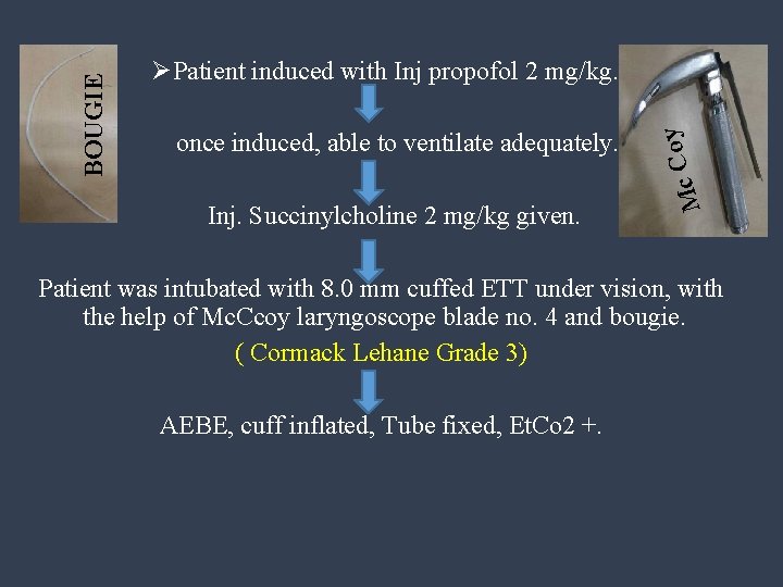 once induced, able to ventilate adequately. Inj. Succinylcholine 2 mg/kg given. oy C c