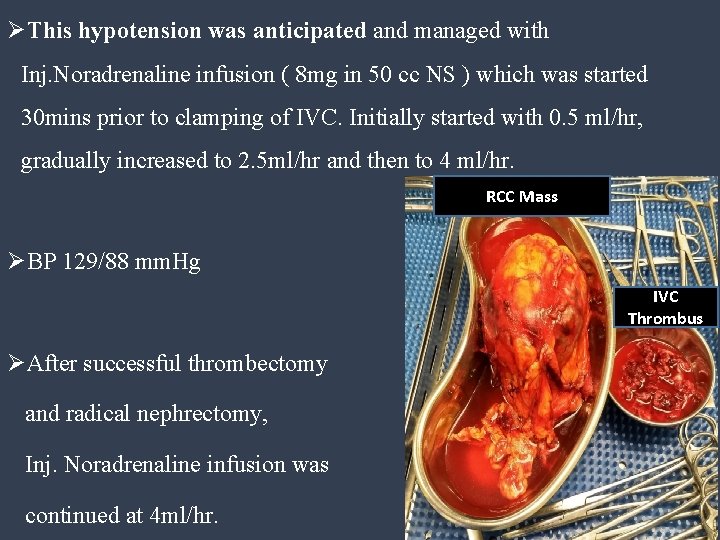 ØThis hypotension was anticipated and managed with Inj. Noradrenaline infusion ( 8 mg in