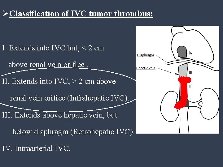 ØClassification of IVC tumor thrombus: I. Extends into IVC but, < 2 cm above