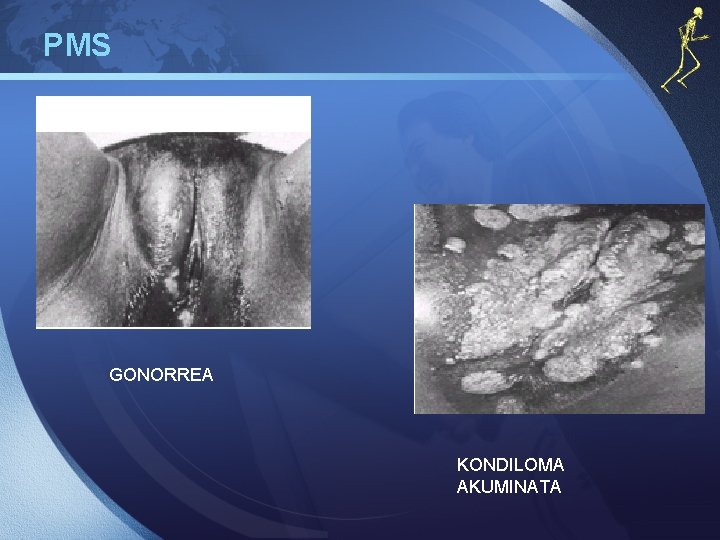 PMS GONORREA KONDILOMA AKUMINATA 