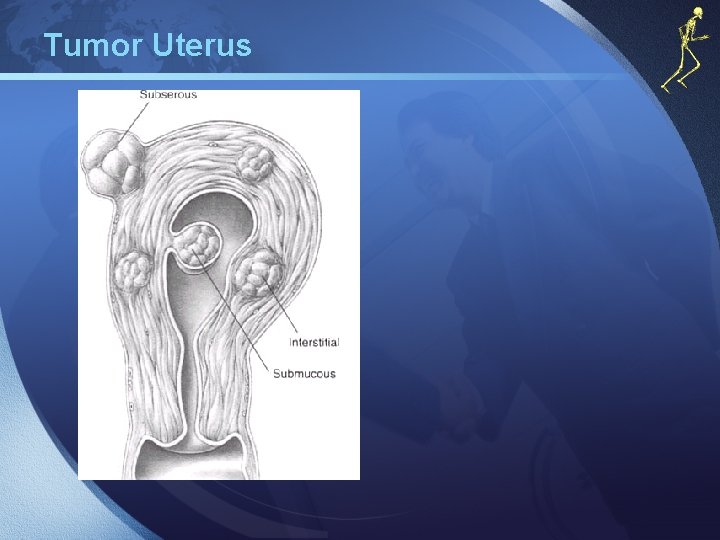 Tumor Uterus 