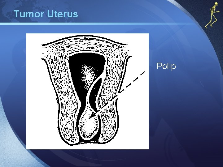 Tumor Uterus Polip 