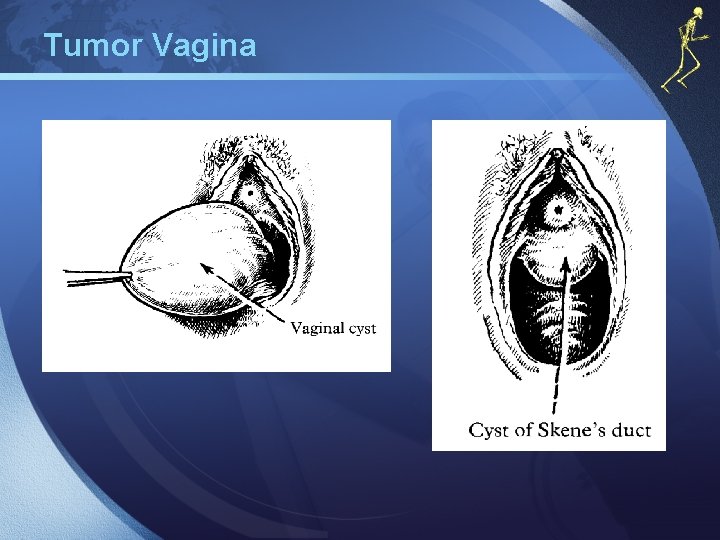 Tumor Vagina 