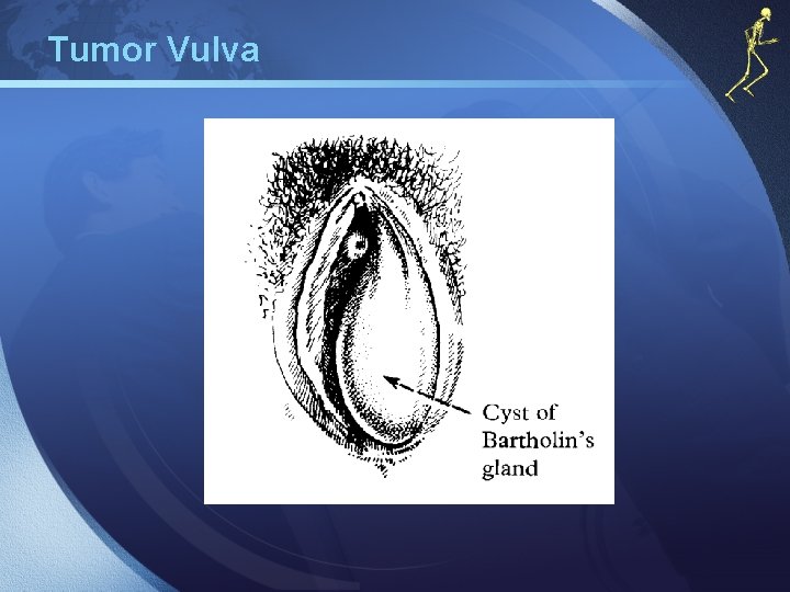 Tumor Vulva 