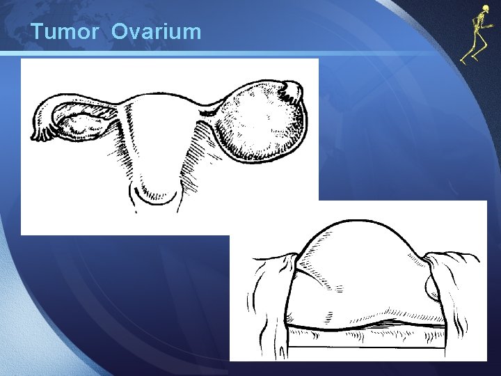 Tumor Ovarium 