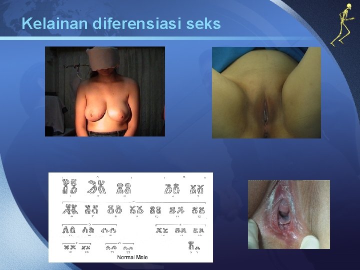 Kelainan diferensiasi seks 