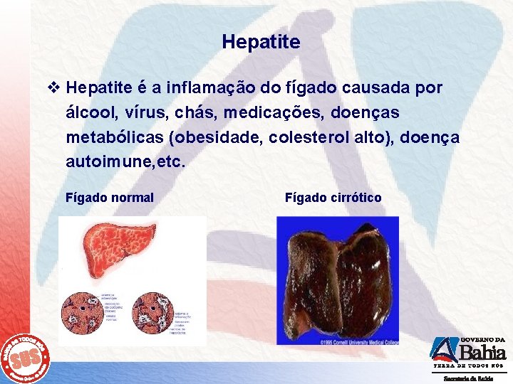 Hepatite v Hepatite é a inflamação do fígado causada por álcool, vírus, chás, medicações,