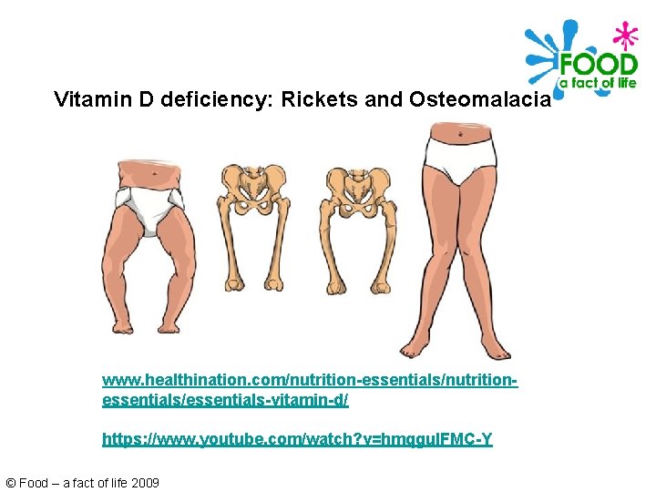 Vitamin D deficiency: Rickets and Osteomalacia www. healthination. com/nutrition-essentials/nutritionessentials/essentials-vitamin-d/ https: //www. youtube. com/watch? v=hmqgu.