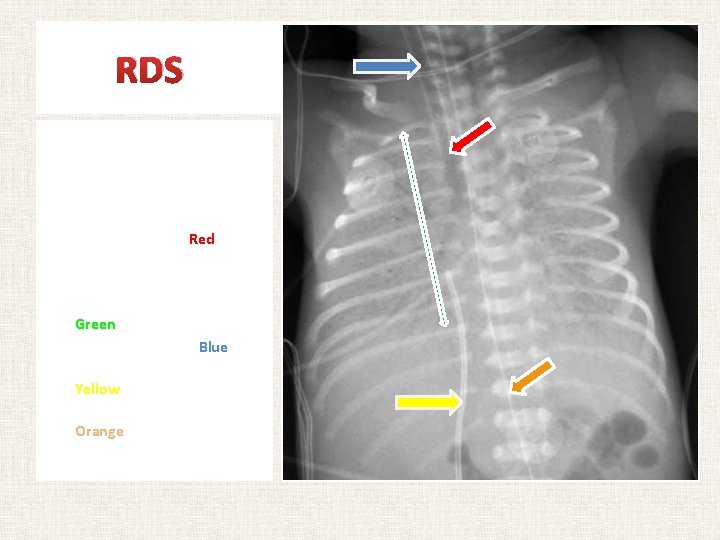 RDS PA view of chest radiograph of an infant with RDS. Notice the following: