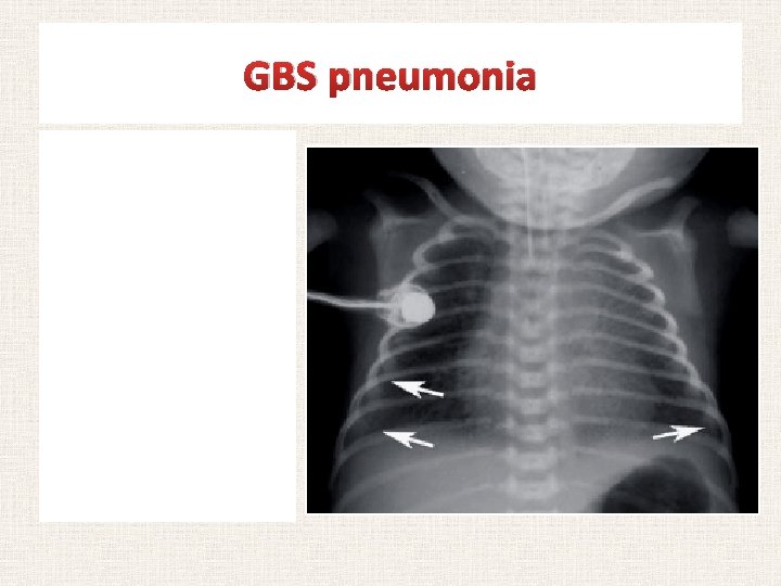 GBS pneumonia Chest radiography of infant with congenital pneumonia. Virtually indistinguishable from one of