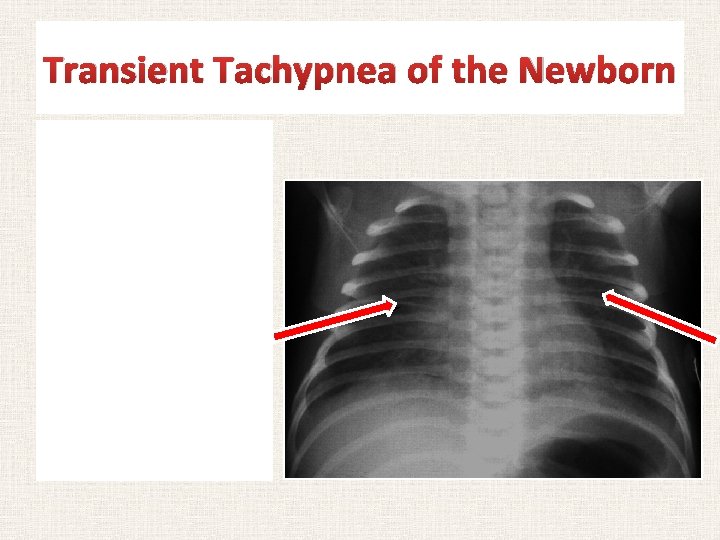 Transient Tachypnea of the Newborn Chest radiograph of an infant with TTNB. Notice the