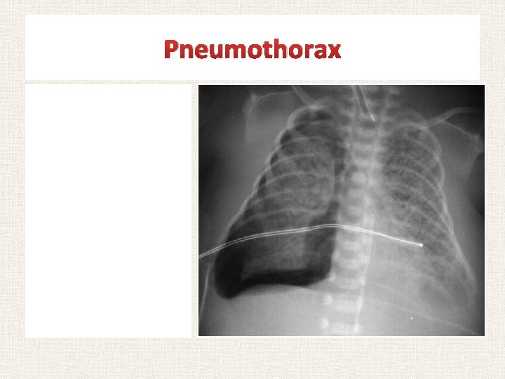 Pneumothorax • • • Aymptomatic (1 -2% of all newborn) Spontaneous vs. secondary Respiratory