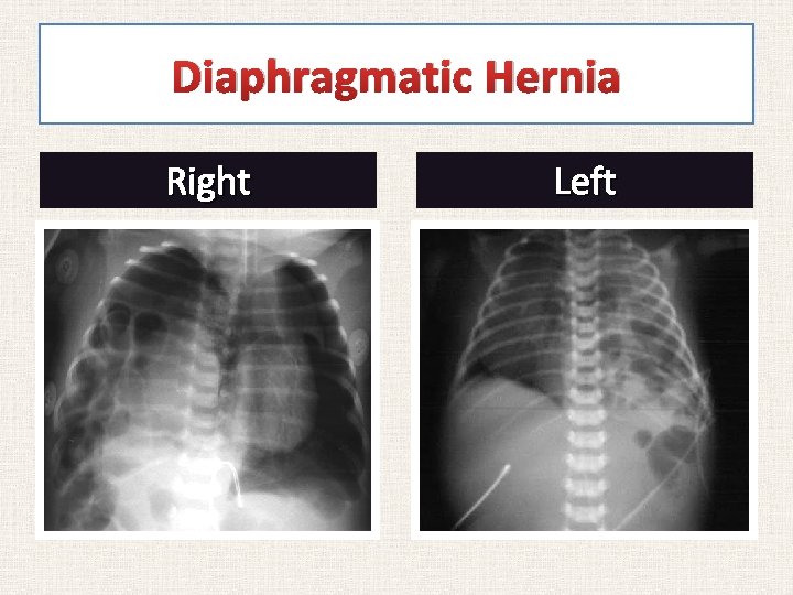 Diaphragmatic Hernia Right Left 