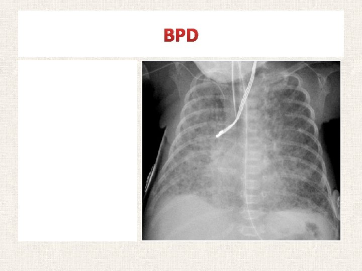BPD Chest radiograph of an infant with BPD Notice the widespread haziness of both