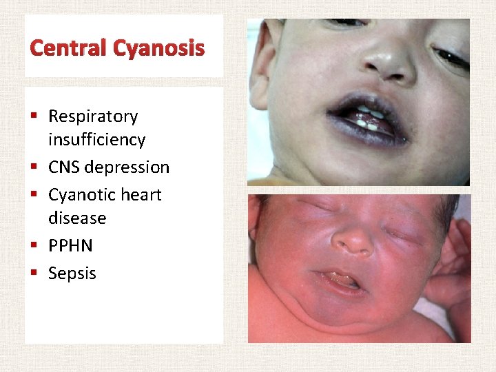 Central Cyanosis § Respiratory insufficiency § CNS depression § Cyanotic heart disease § PPHN