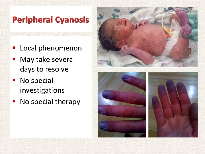 Peripheral Cyanosis § Local phenomenon § May take several days to resolve § No