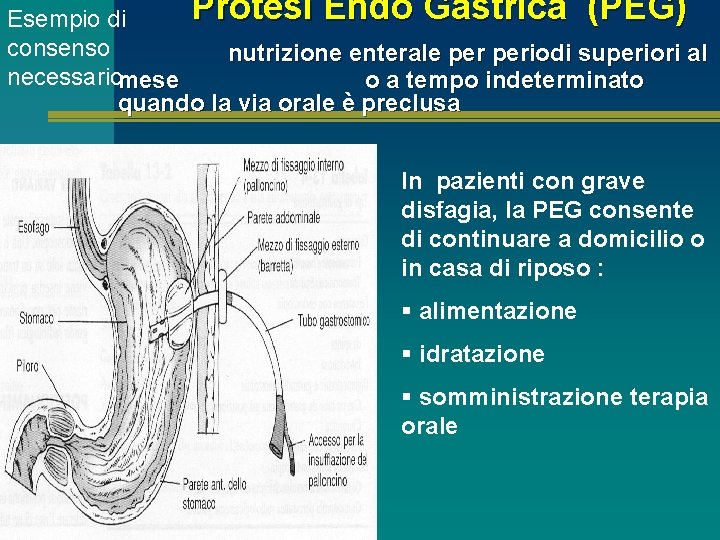 Protesi Endo Gastrica (PEG) Esempio di consenso nutrizione enterale periodi superiori al necessariomese o