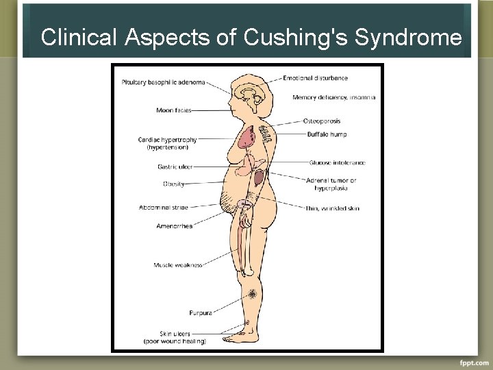 Clinical Aspects of Cushing's Syndrome 