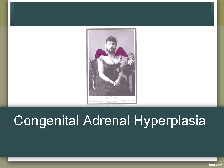 Congenital Adrenal Hyperplasia 