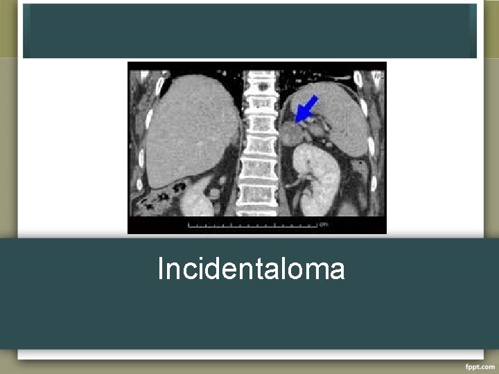 Incidentaloma 