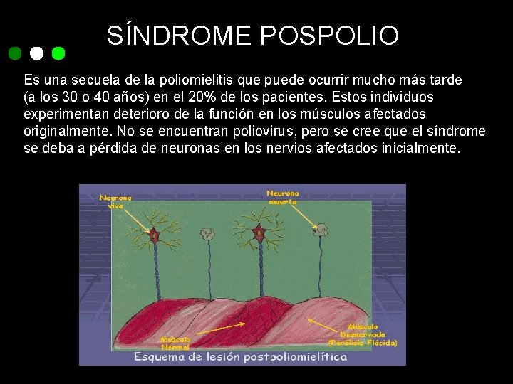 SÍNDROME POSPOLIO Es una secuela de la poliomielitis que puede ocurrir mucho más tarde