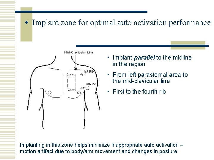 w Implant zone for optimal auto activation performance • Implant parallel to the midline