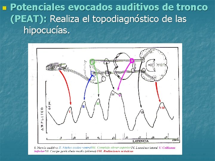 n Potenciales evocados auditivos de tronco (PEAT): Realiza el topodiagnóstico de las hipocucías. 