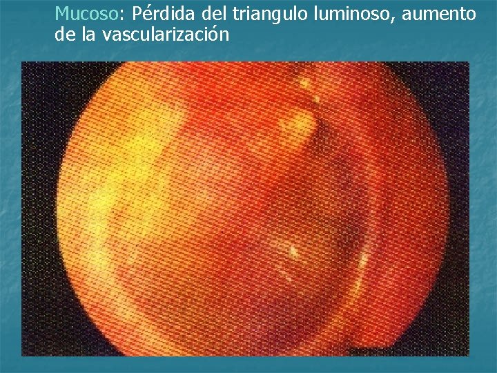 Mucoso: Pérdida del triangulo luminoso, aumento de la vascularización 