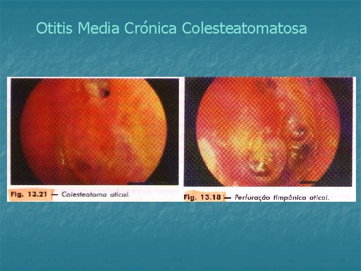 Otitis Media Crónica Colesteatomatosa 