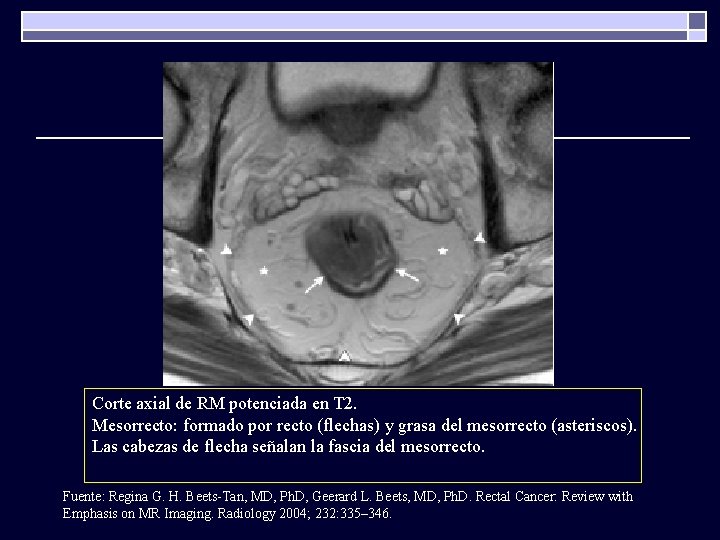 Corte axial de RM potenciada en T 2. Mesorrecto: formado por recto (flechas) y