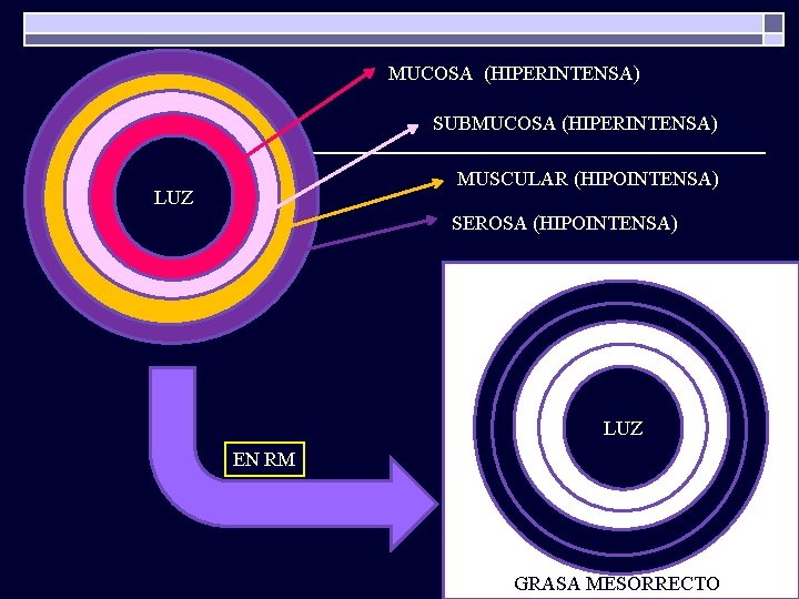 MUCOSA (HIPERINTENSA) SUBMUCOSA (HIPERINTENSA) MUSCULAR (HIPOINTENSA) LUZ SEROSA (HIPOINTENSA) LUZ EN RM GRASA MESORRECTO