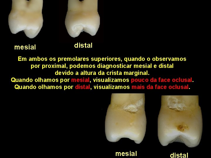 mesial distal Em ambos os premolares superiores, quando o observamos por proximal, podemos diagnosticar