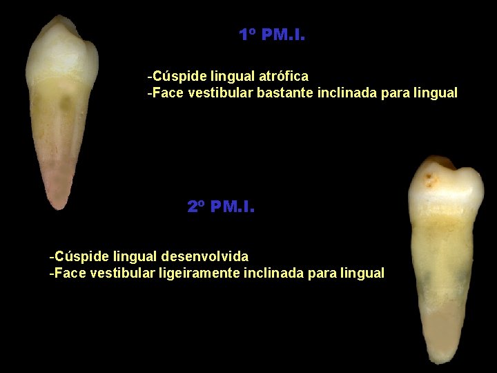 1º PM. I. -Cúspide lingual atrófica -Face vestibular bastante inclinada para lingual 2º PM.