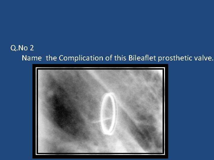 Q. No 2 Name the Complication of this Bileaflet prosthetic valve. 