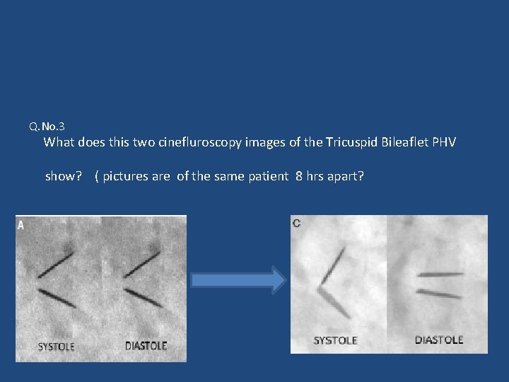 Q. No. 3 What does this two cinefluroscopy images of the Tricuspid Bileaflet PHV