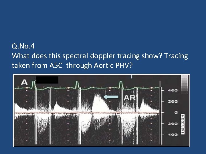 Q. No. 4 What does this spectral doppler tracing show? Tracing taken from A