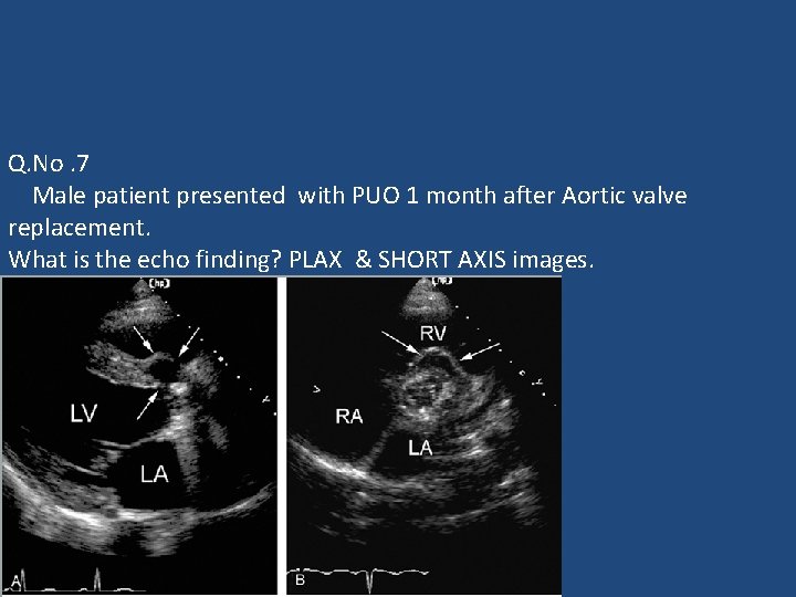 Q. No. 7 Male patient presented with PUO 1 month after Aortic valve replacement.