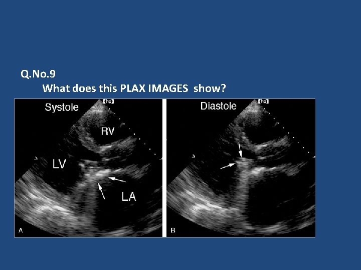 Q. No. 9 What does this PLAX IMAGES show? 