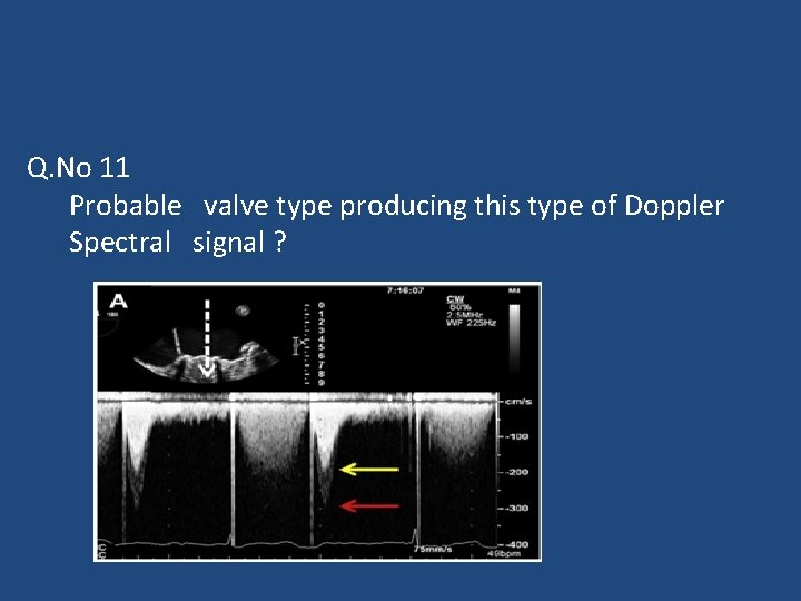 Q. No 11 Probable valve type producing this type of Doppler Spectral signal ?