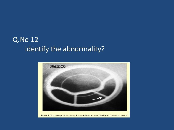 Q. No 12 Identify the abnormality? 