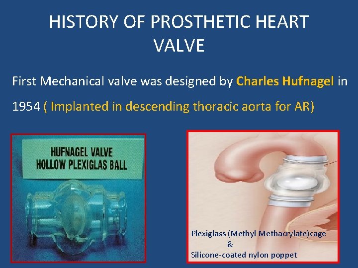 HISTORY OF PROSTHETIC HEART VALVE First Mechanical valve was designed by Charles Hufnagel in