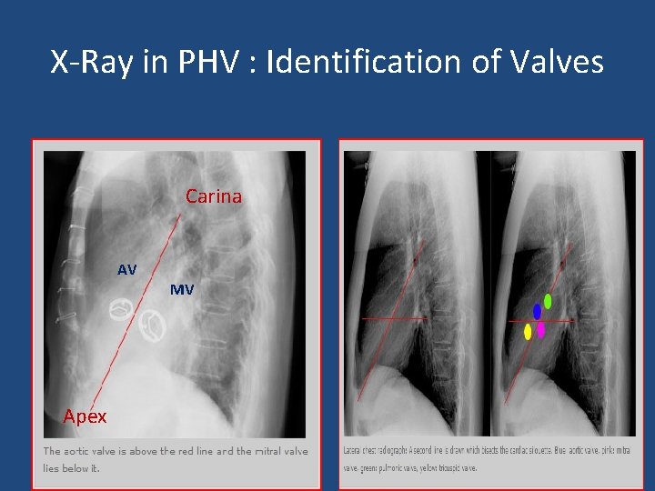 X-Ray in PHV : Identification of Valves Carina AV MV Apex 