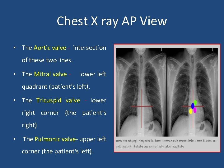 Chest X ray AP View • The Aortic valve - intersection of these two