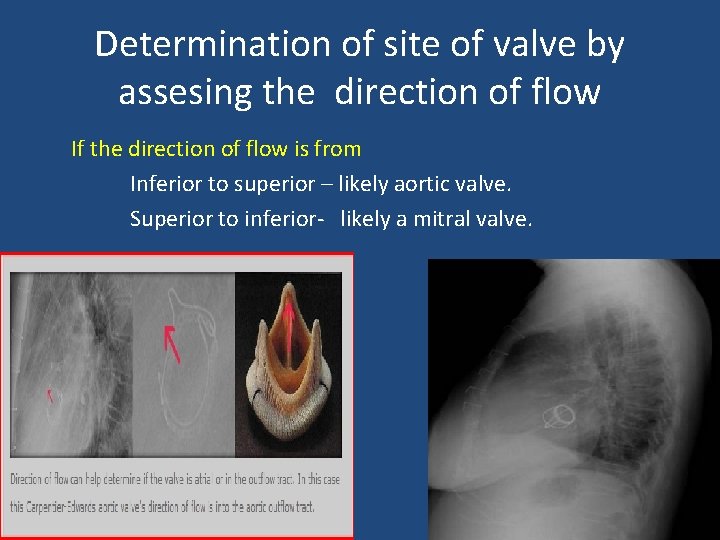 Determination of site of valve by assesing the direction of flow If the direction